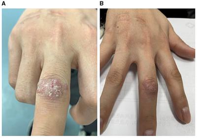 Mycobacterium marinum hand infection: a case report and literature review